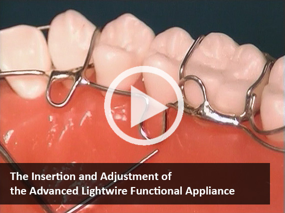 The Insertion and Adjustment of Advanced Lightwire Appliance (Video)