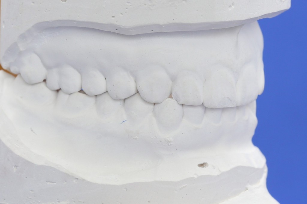 Occlusal wear