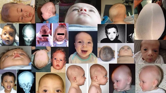 Skull distortions in infants